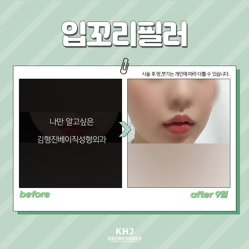 입꼬리필러모양 자연스럽게 원하신다면 관련 이미지 4