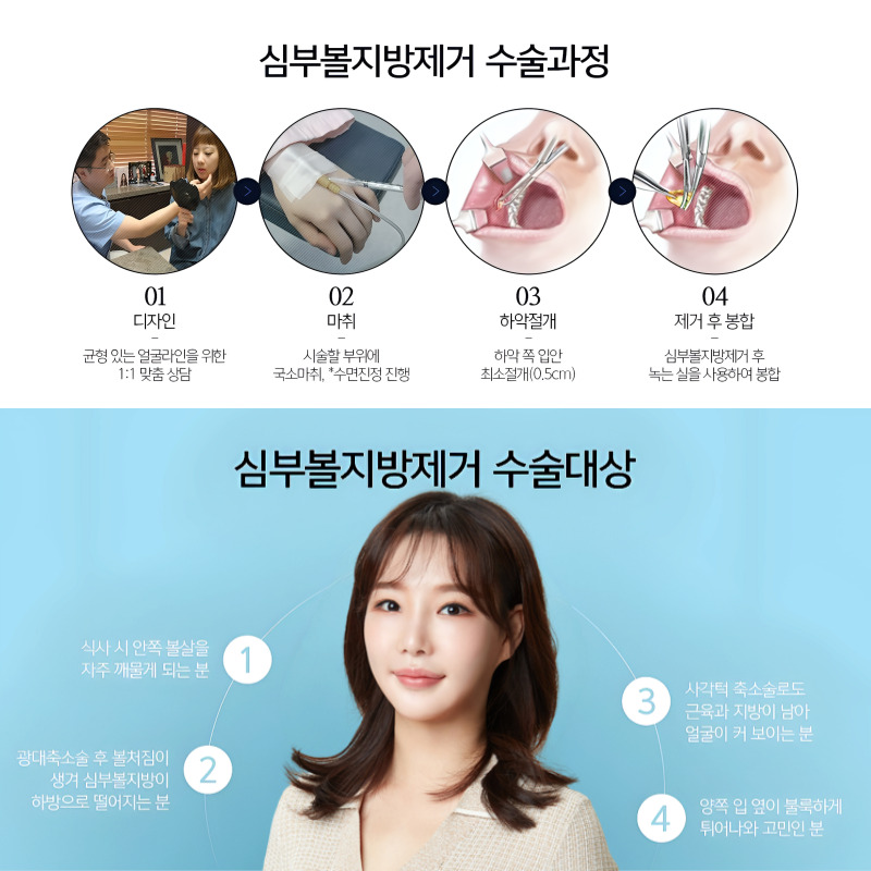 울퉁불퉁 얼굴형, 심부볼지방제거수술 받으면 어떻게 될까? 관련 이미지 5