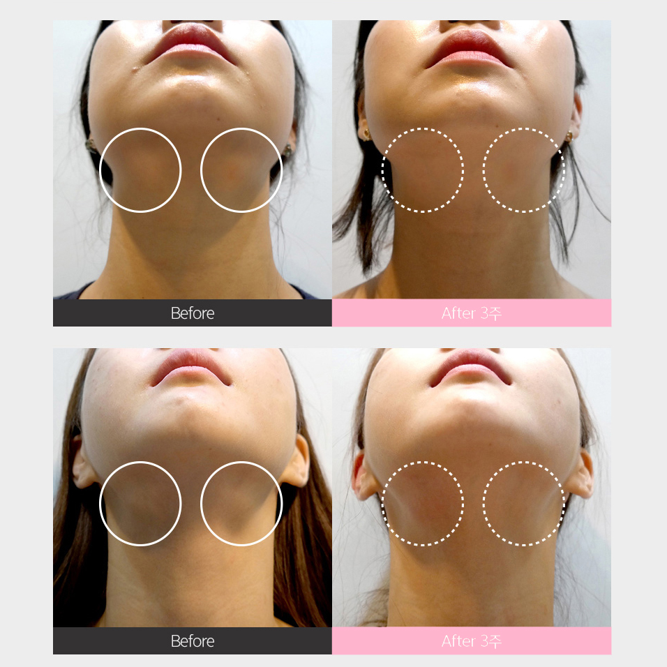 I’m Extremely Satisfied with Seoul Salivary Gland Botox image 6