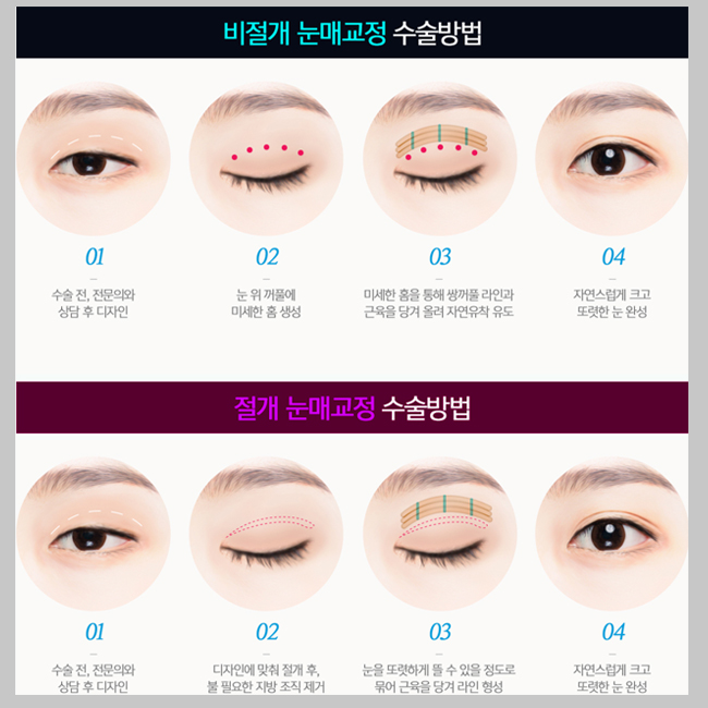 비절개눈매교정술 vs 절개눈매교정술 맞춤 눈 완성 관련 이미지 3