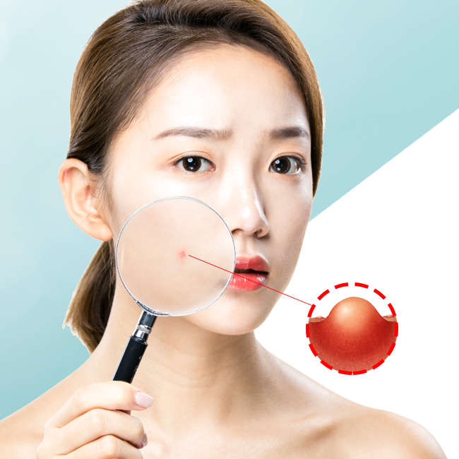 좁쌀여드름압출로 성인여드름 타파 ! 관련 이미지 2