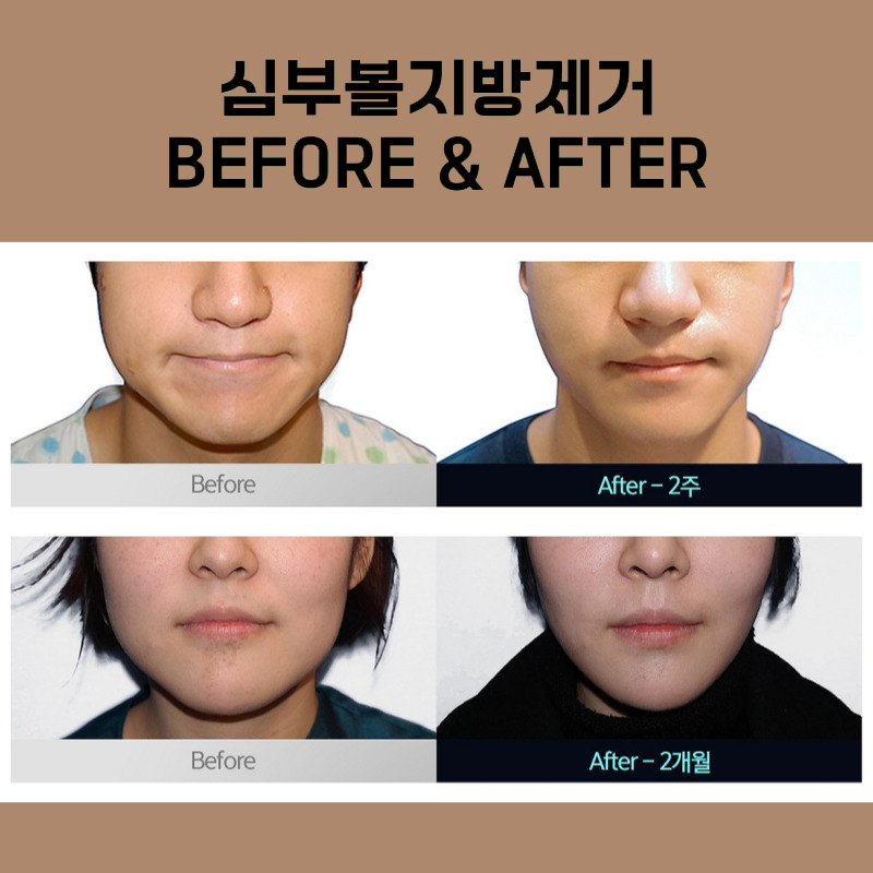 How to Get Rid of Deep Cheek Fat: This Has Truly High Satisfaction image 5