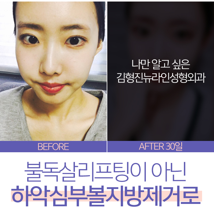 불독살 리프팅으론 안된다구요 관련 이미지 2