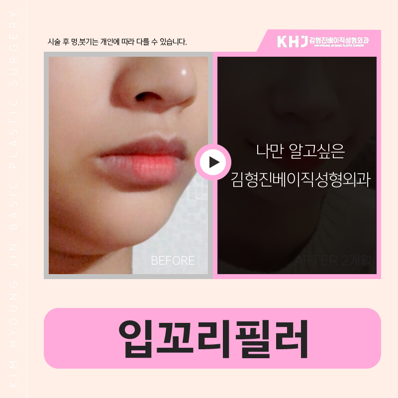 역대급 강남입꼬리필러후기 보고 갈 사람? 관련 이미지 5