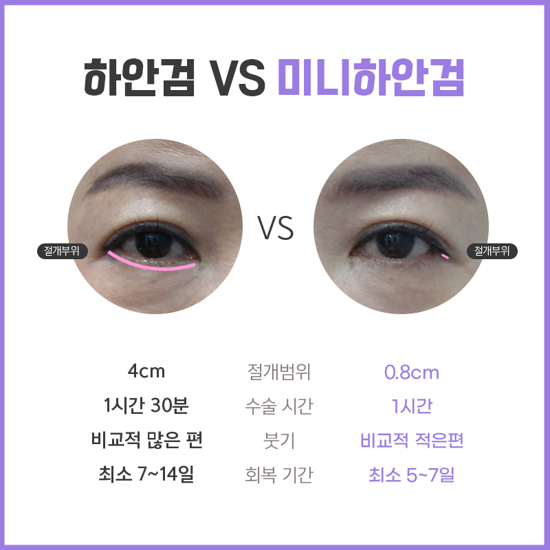 중년눈수술병원 어느 병원이 좋을지 모르겠다면 관련 이미지 4