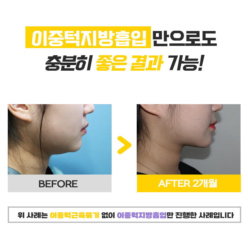 다이어트 없이 이중턱없애는방법 이것만이 답입니다 관련 이미지 6