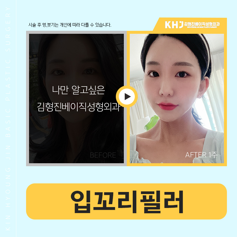 입꼬리필러전후 확실하게 관련 이미지 4