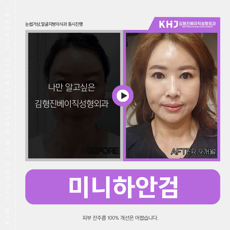 미니하안검병원 자연스럽게 잘해주는곳 찾고있다면 관련 이미지 5