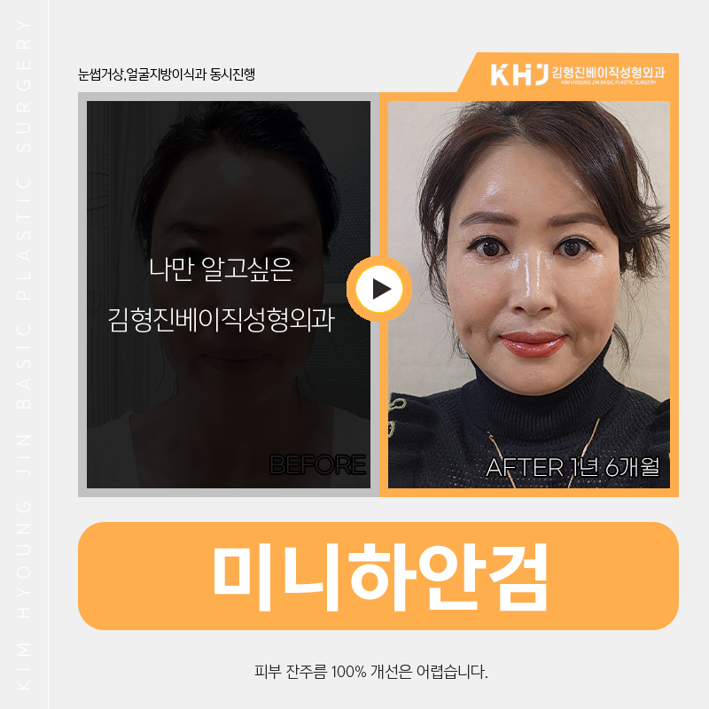 효도성형추천 변화가 확실한 김형진베이직의 미니하안검 관련 이미지 6