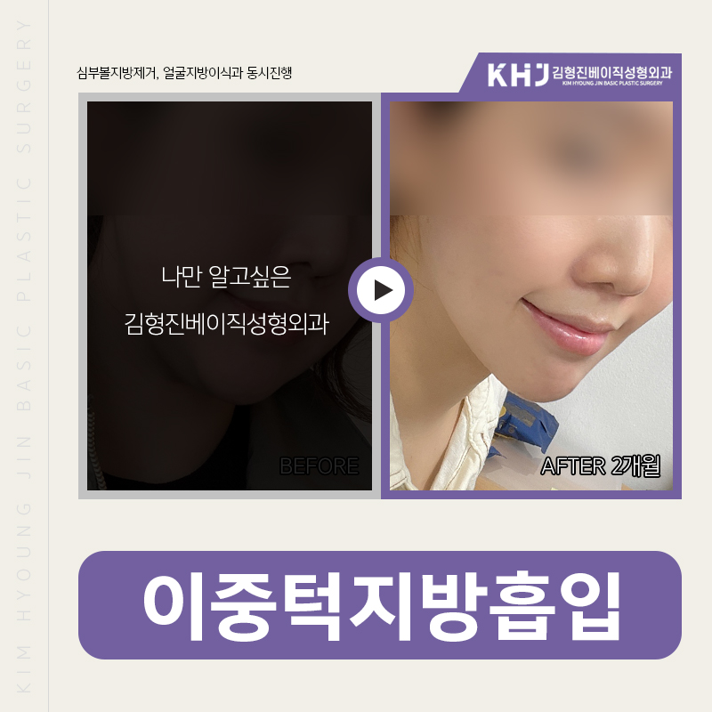 이중턱지방흡입흉터 안 보여요! 관련 이미지 4