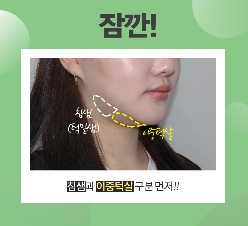 침샘보톡스 하나로 두턱없애기 관련 이미지 2