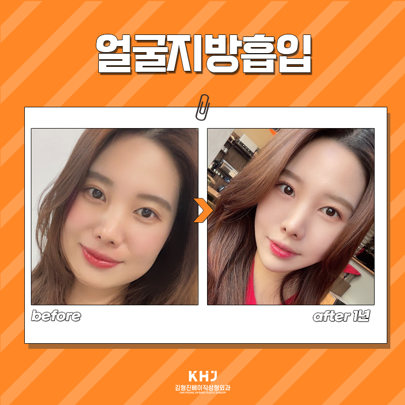 얼굴지방흡입잘하는곳에서 갸름한 얼굴 완성했어요 관련 이미지 6