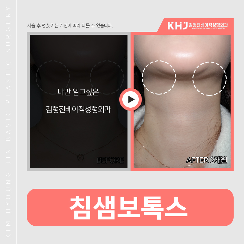 침샘비대증치료방법 간단해요! 관련 이미지 4