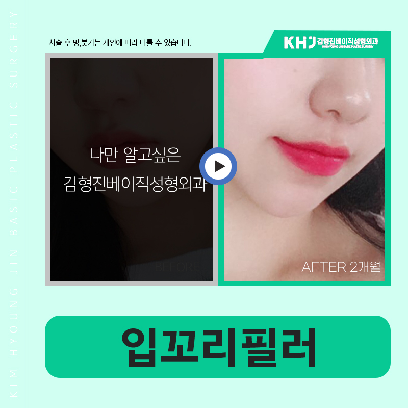 You can create more vibrant lips with just a mouth-corner filler procedure! image 6