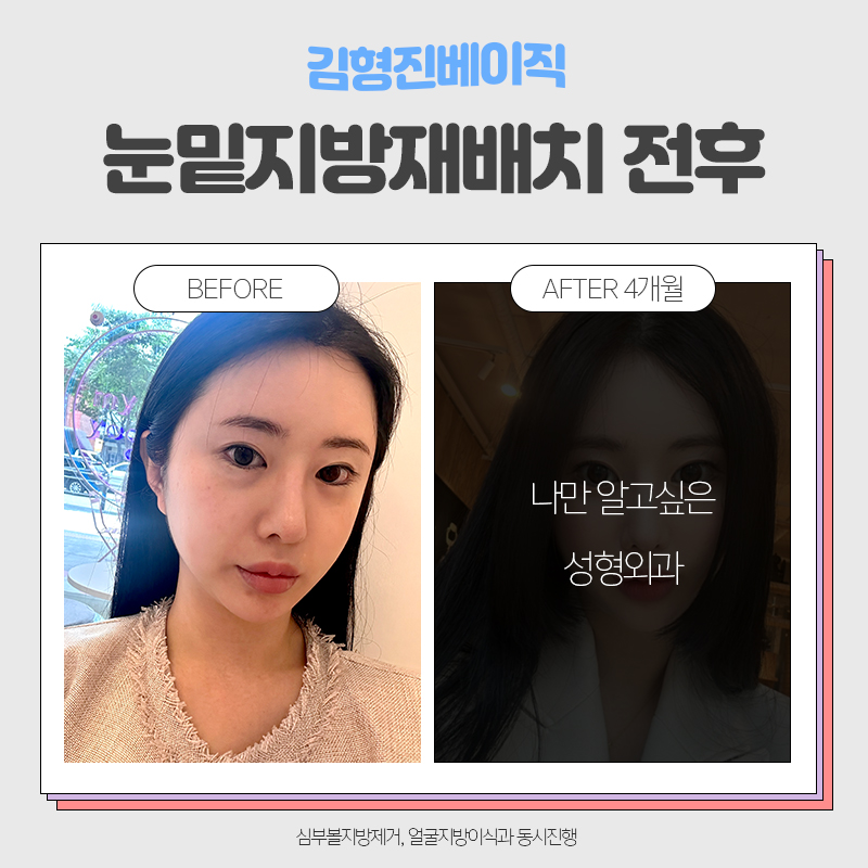 눈밑지방재배치전후 보러오실분 관련 이미지 4