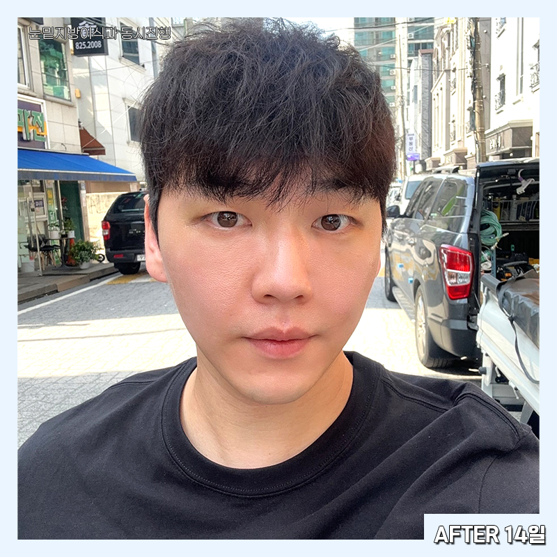 눈밑지방재배치변화과정 한눈에 확인하고 가세요! 관련 이미지 6