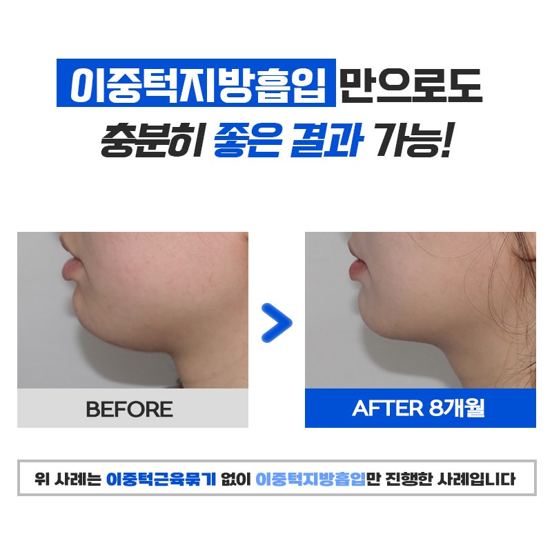 스트레스였던 턱살, 이중턱지방제거 하고 턱선 살아났어요 관련 이미지 6