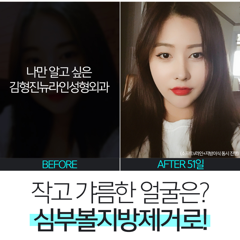비수술안면윤곽 이거 완전 그뤠잇! 관련 이미지 6