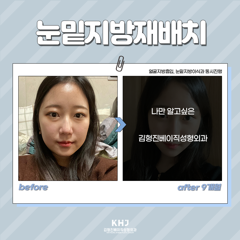눈밑재수술 걱정 덜어놓으셔도 되는 이유 관련 이미지 2