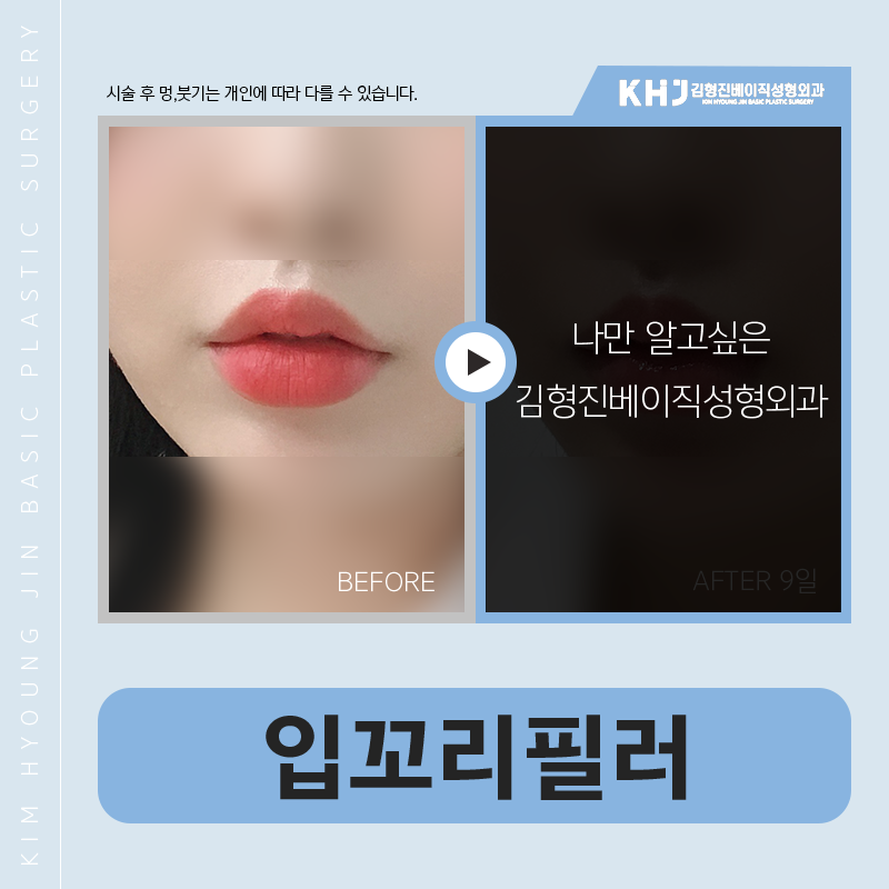 입꼬리필러모양 세심하게 잡아주는 곳 찾으신다면? 관련 이미지 3