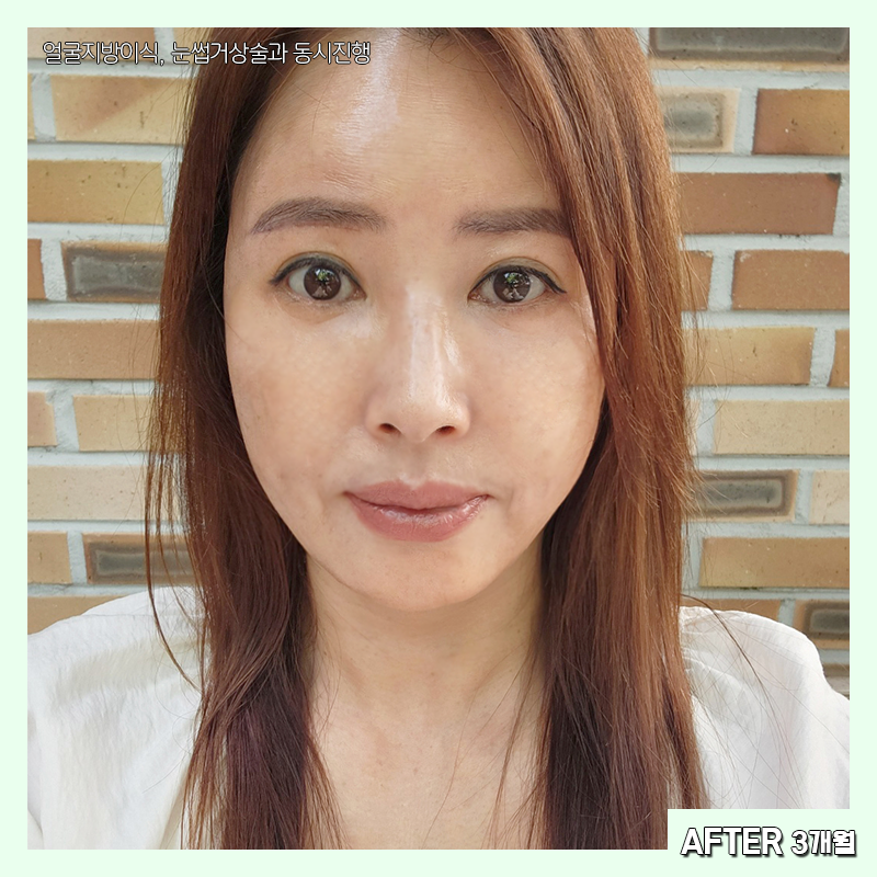 미니하안검붓기 궁금하셨다구요? 관련 이미지 6