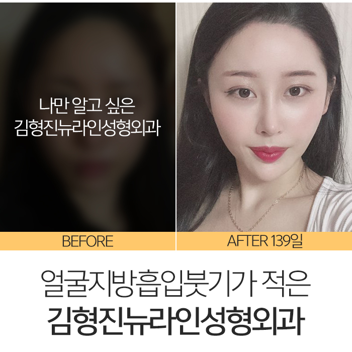 얼굴지방흡입붓기 솔직히 없을 순 없어요 관련 이미지 7
