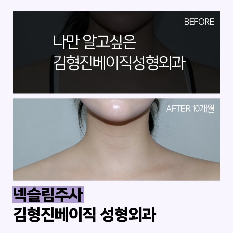 넥슬림주사로 이쁜 목라인 만들기 관련 이미지 3