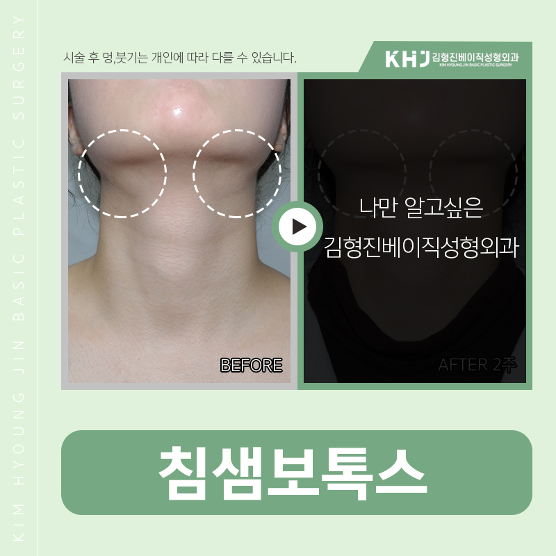 침샘보톡스주기 어떻게 되냐면요 관련 이미지 3