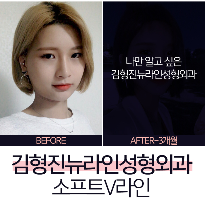 윤곽후볼처짐 해결책은 김형진뉴라인성형외과 소프트V라인 관련 이미지 7