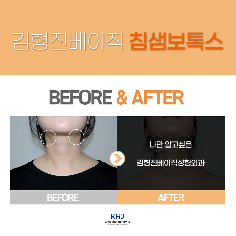 턱밑침샘보톡스효과 확인하고 가세요! 관련 이미지 5