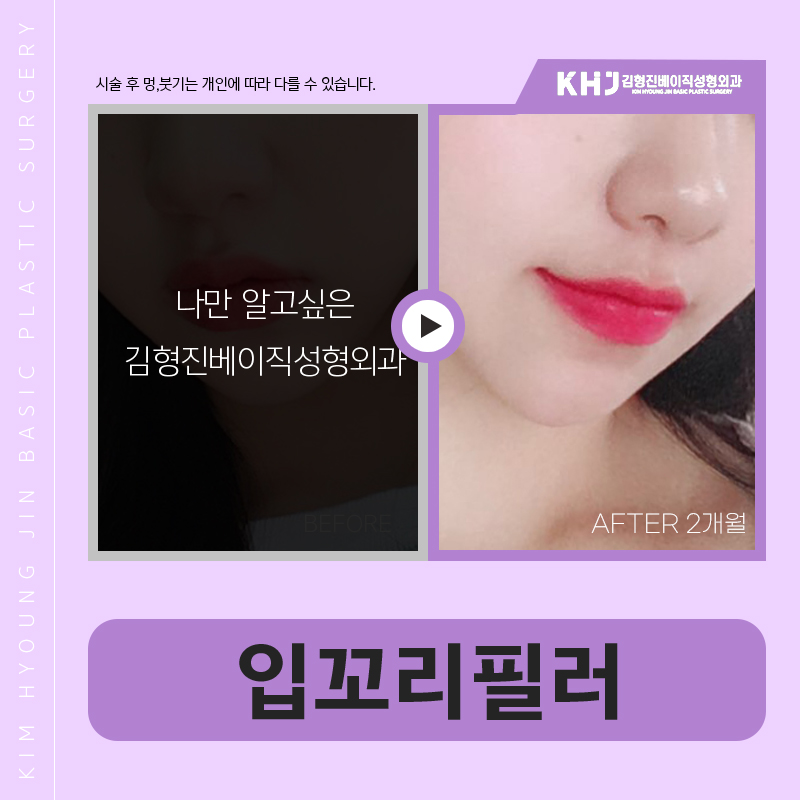 입꼬리필러효과 무표정에도 기분 좋아 보이는 인상으로! 관련 이미지 6