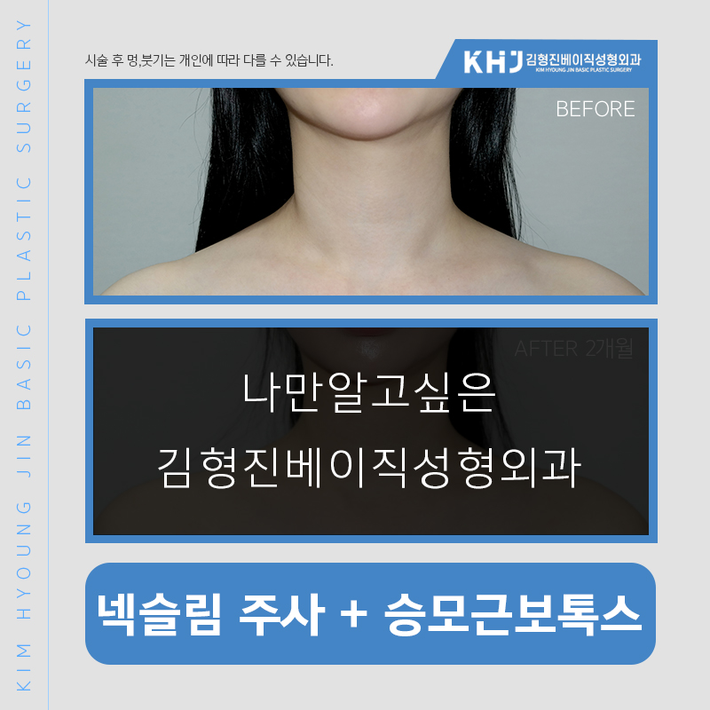 넥슬림보톡스 누가 해야되냐면요 관련 이미지 4