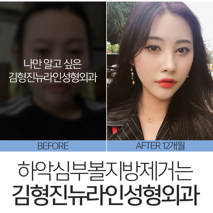 하악심부볼지방제거 보면 놀라요 관련 이미지 2