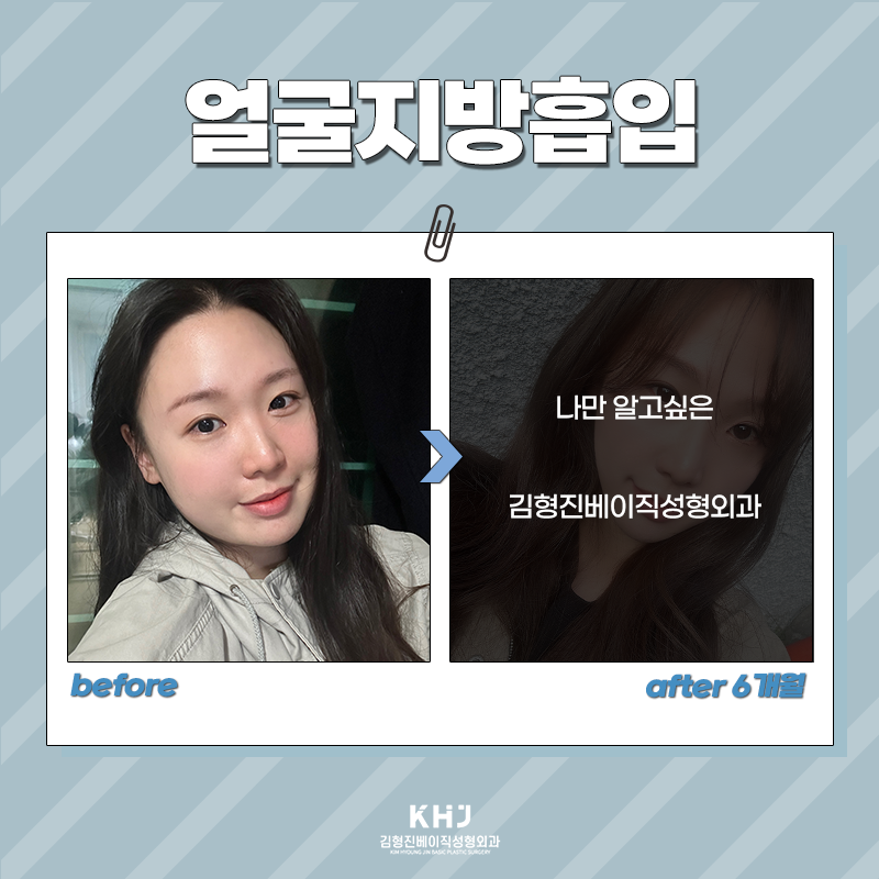 얼굴지방흡입잘하는곳 찾고 계셨다면? 관련 이미지 3