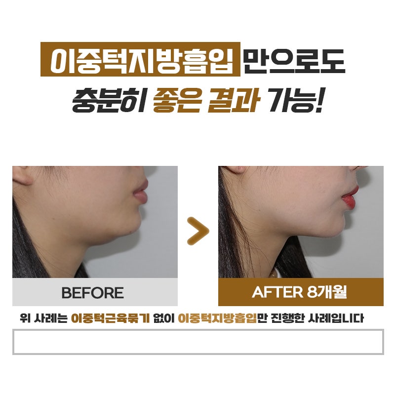 이중턱지흡으로 또렷한 턱선 만들고 싶다면 관련 이미지 6