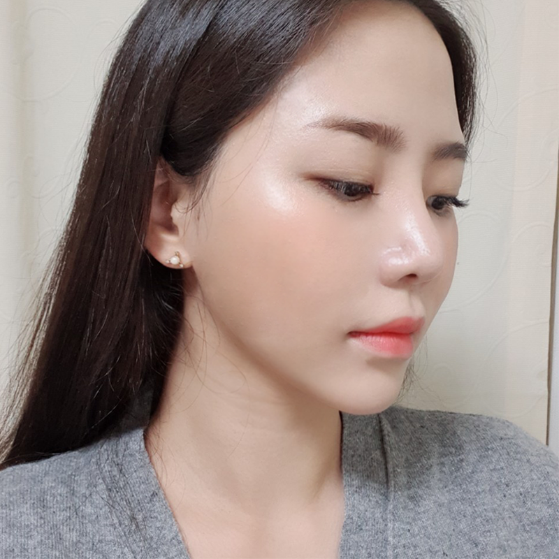 침샘비대증치료 이렇게 간단한 방법이? 관련 이미지 4