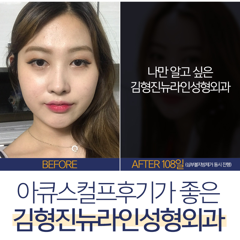아큐스컬프후기 아주 좋아 관련 이미지 2