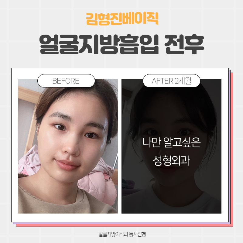 얼굴지흡후기 좋은 이유 궁금하시죠? 관련 이미지 2