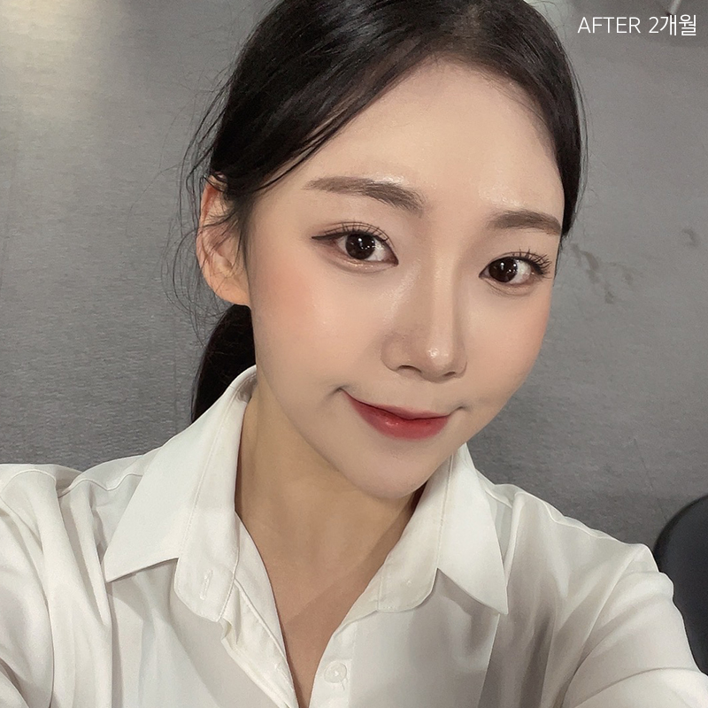 심부볼  보톡스 효과 없었던 건 관련 이미지 5