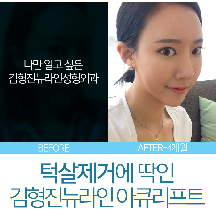 남자턱살제거 이렇게 해야지 관련 이미지 5