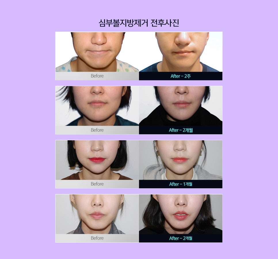 얼굴 라인 정리하고 빠르게 볼살빼는법 관련 이미지 5