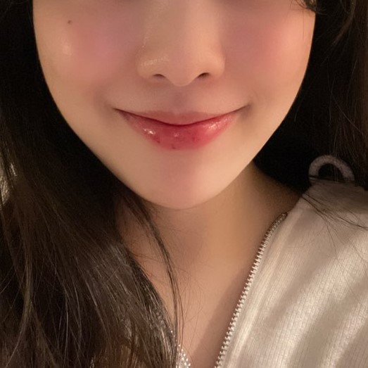 압구정에서 입꼬리시술 하고 만족도 최상이에요 관련 이미지 3