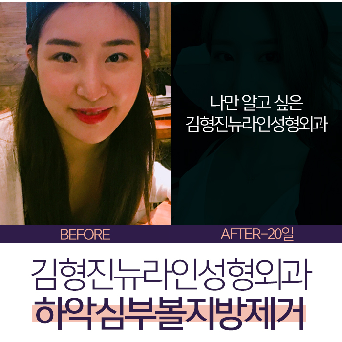 하악심부볼지방제거 볼패임을 잡다 관련 이미지 1