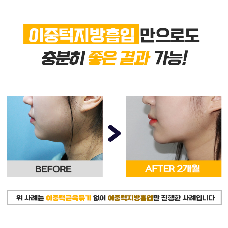 이중턱지방없애는법은 이것만 아셔도 됩니다 관련 이미지 8