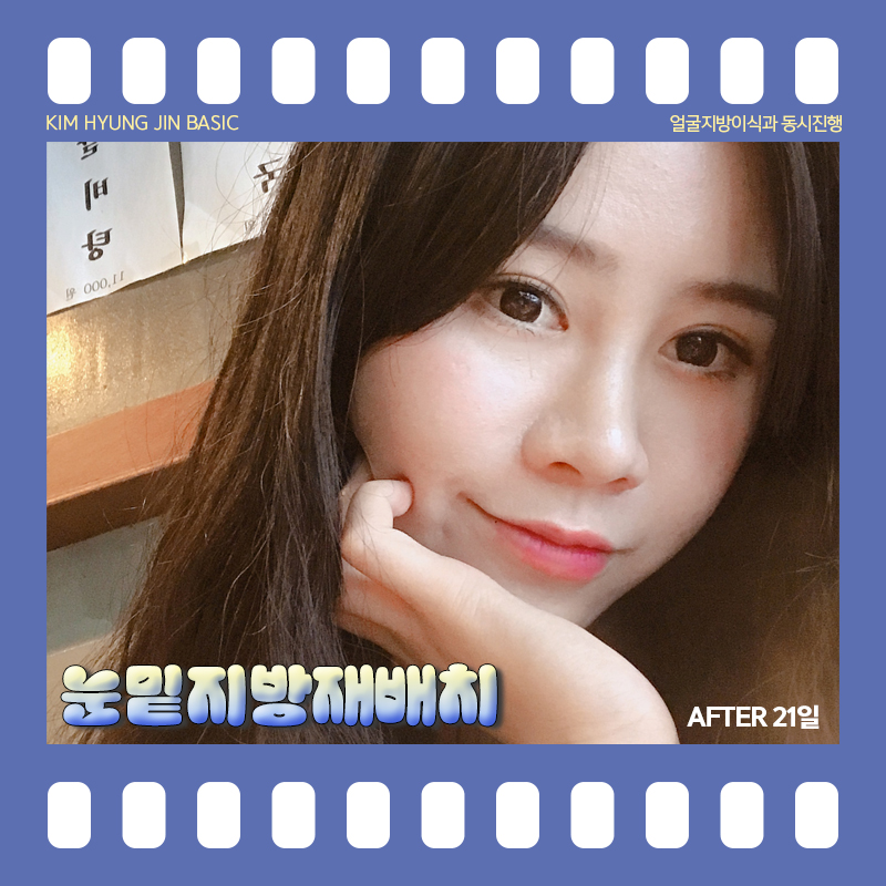 눈밑지방재배치통증! 걱정 안해도 되는 이유 관련 이미지 5