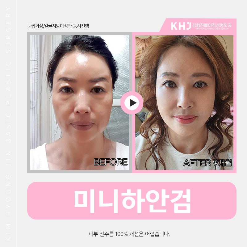 압구정하안검 잘하는 곳 찾고 있다면 관련 이미지 5