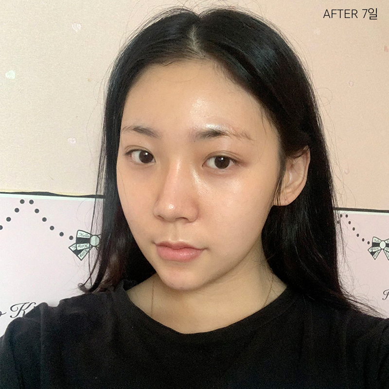 심부볼  보톡스 효과 없었던 건 관련 이미지 3