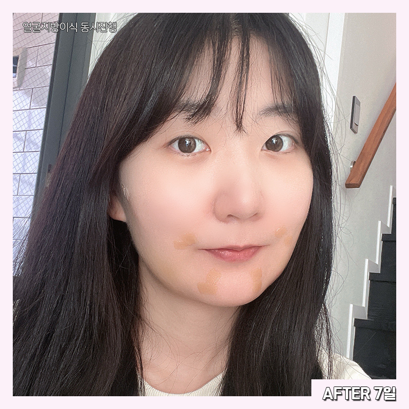 얼굴지방흡입효과 제대로 보려면 관련 이미지 4