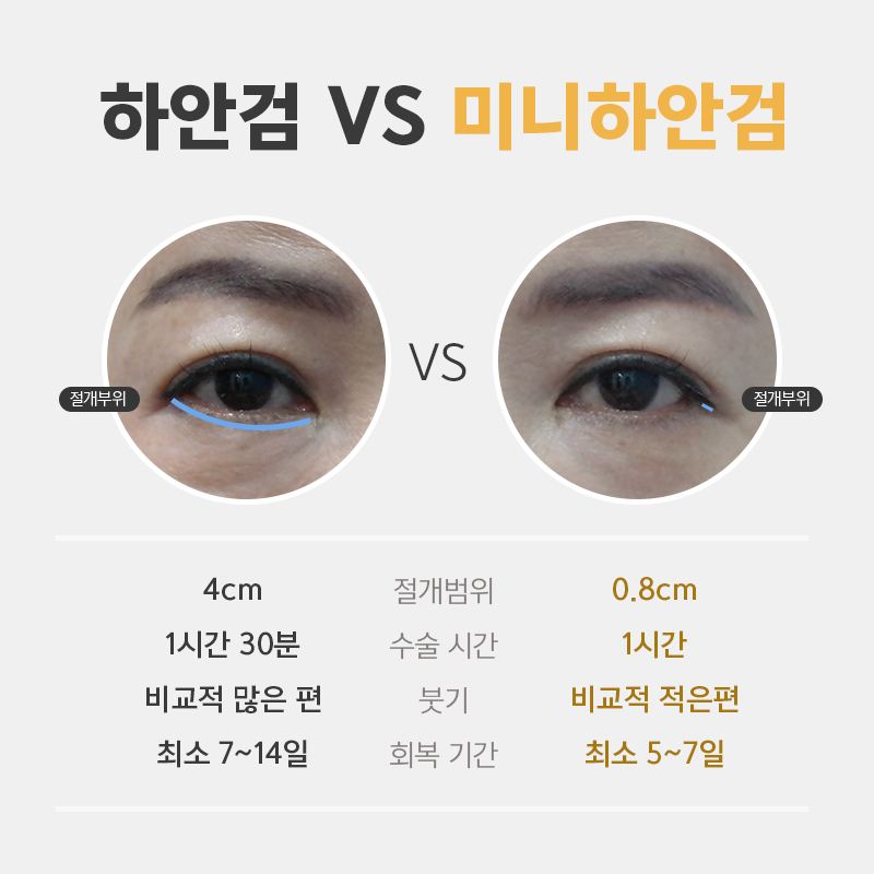 미니하안검절개 깔끔한 곳 찾으신다면 관련 이미지 3