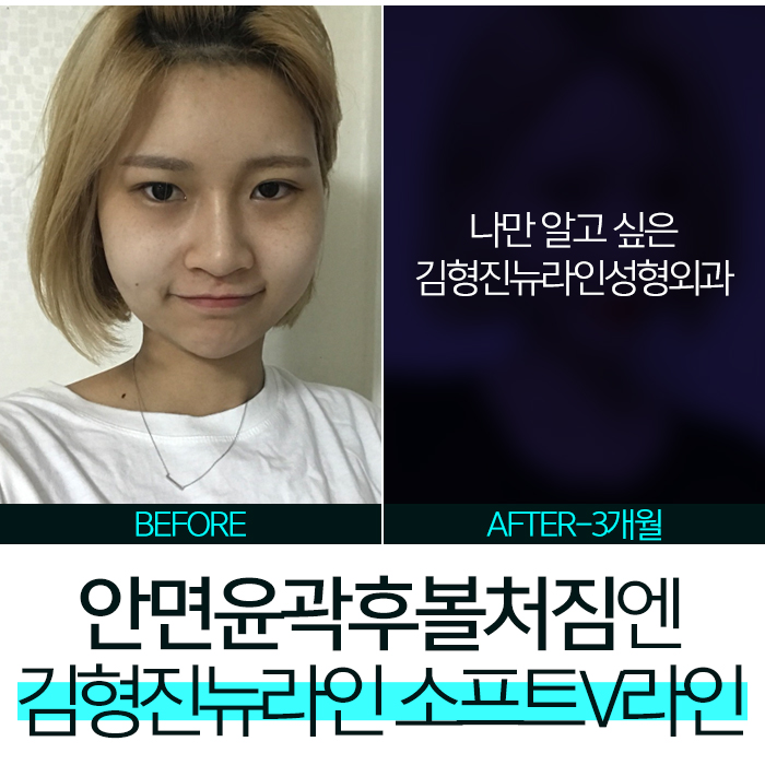 안면윤곽수술후볼처짐 진짜 해결책은 따로 있어! 관련 이미지 8